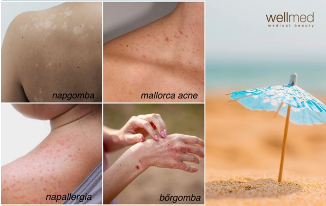 Nyári bőrbetegségek