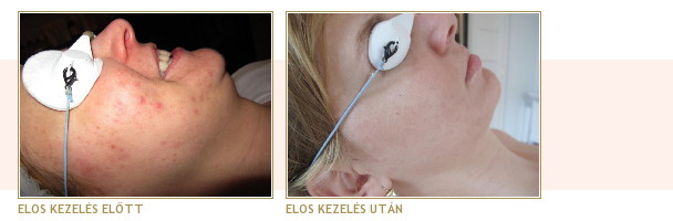 Akne kezelés előtt - után Akne kezelés előtt - után