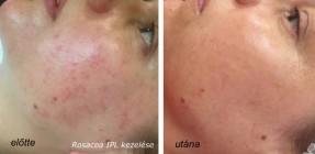 Rosacea IPL+RF kezelése