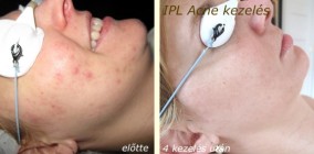 acne kezelés IPL fénykezeléssel