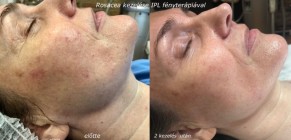 Rosacea IPL kezelése